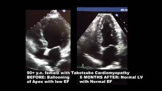 2d Echocardiogram takotsubo Cardiomyopathy [upl. by Sonni]