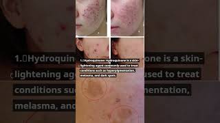 What are Uses of Hydroquinone Tretinoin Mometasone furoate Creammometasonefuorateshortsfeedyt [upl. by Annodas]