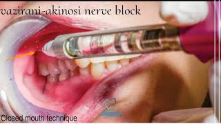 vaziraniakinosi nerve block technique  Local anesthesia for mandibular teeth [upl. by Lsiel165]