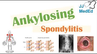 Ankylosing Spondylitis  HLAB27 Pathophysiology Signs amp Symptoms Diagnosis Treatment [upl. by Orton445]