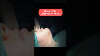 Under Chin Liposuction  Under Chin Fat Removal  Chin Liposuction Before After SB Aesthetics [upl. by Bilac]