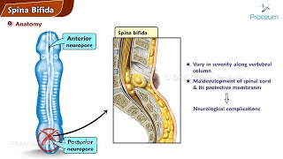 Spina Bifida  Orthopedics Lecture [upl. by Isayg860]