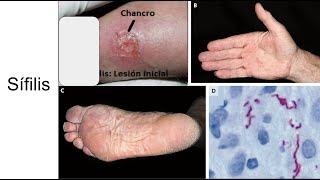 Sífilis Etapas de la infección diagnóstico y tratamiento [upl. by Franciskus161]