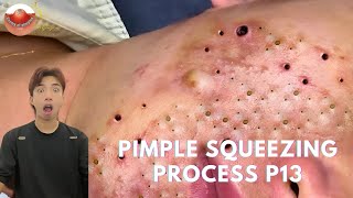 The MOST TERRIFYING Acne Squeezing Videos Youve Ever Seen 13 [upl. by Leodora760]