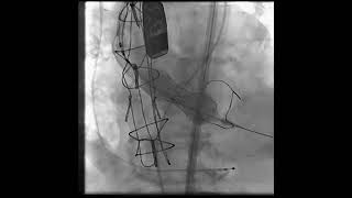 TAVR valve deployment while rapid pacing [upl. by Baseler]