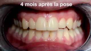 Facettes dentaires Cerec  veneers by PAG vs Ceramic crown [upl. by Oiliduab]