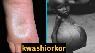 kwashiorkor and its symptoms [upl. by Inavoj]