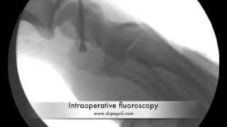 Percutaneous Scaphoid Fixation [upl. by Rutherfurd33]