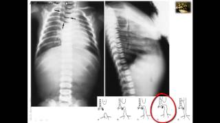 Embryology of Congenital Anomalies of the Foregut 1 [upl. by Sidoon]