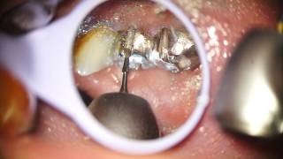 Indepartare ablatie lucrare dentara fara durere Dental crown removal Painless [upl. by Concepcion]