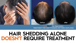 Excessive Hair Shedding vs Hair Loss  Why Conditions Like Telogen Effluvium Dont Require Treatment [upl. by Shell128]