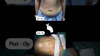 Do You Have Loose Belly Skin   Female Tummy Tuck Surgery Before After Result on Table [upl. by Norbel843]