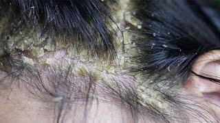 Dandruff scratching removal on head using black combing394 [upl. by Storfer]