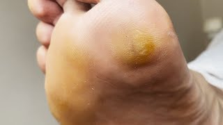 Professional treating cracked  Cracked treatment amp Callus removal  ASMR PART 1 [upl. by Utimer]