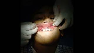 Eneucleation of periapical cyst [upl. by Proctor]