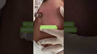 What does Microdermabrasion do for your face  Results Laser Clinic [upl. by Nnael]