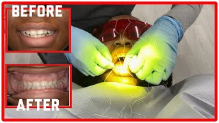 BRACES UPDATE  5  Journey To Get My Braces Removed Permanent Retainer Vlog Style Brace’s Diary [upl. by Kathie]