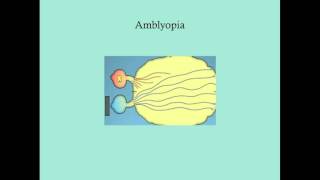 Amblyopia  CRASH Medical Review Series [upl. by Eslud]