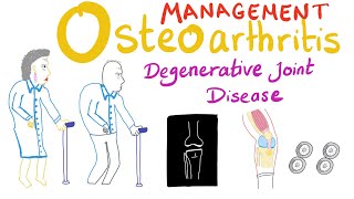 Osteoarthritis OA  Treatment  Degenerative Joint Disease  Rheumatology Series [upl. by Dari958]