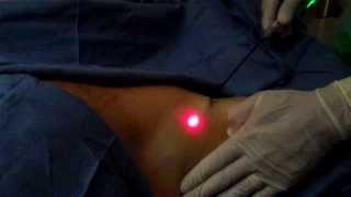 Laser Sweat Gland Ablation in Pearland TX [upl. by Samp]