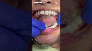 Invisalign Braces  Aligners for Teeth  Invisalign Time Lapse  invisalign invisalignsmile short [upl. by Lovmilla154]