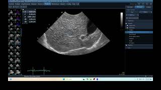 IQ 276 LIVER HEPATOMA PDH ULTRASOUND ECHOPAC ANALYSIS [upl. by Leasi]