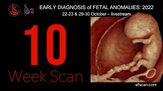 10 Week Scan  EARLY DIAGNOSIS of FETAL ANOMALIES 2022 [upl. by Kaz]