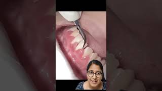 GINGIVAL INFLAMMATION  GINGIVITIS  shortsfeed youtubeshorts dentalclinic AS dental care viral [upl. by Annoeik8]