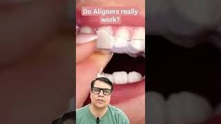 Do Aligners Really work youtubeshorts shortvideo shorts short teeth braces aligners [upl. by Reeve664]