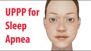 Uvulopalatopharyngoplasty UPPP for Sleep Apnea in Adults [upl. by Hadeehuat476]