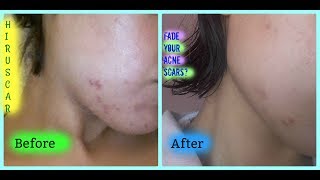 How to Fade Acne Scars Before amp After Pics Hiruscar Review amp Demo [upl. by Narej]