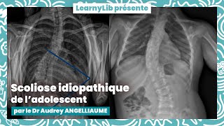 🩺 Pédiatrie  la scoliose idiopathique de ladolescent avec le Dr Audrey ANGELLIAUME [upl. by Erusaert]