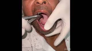 Tooth extraction of a firm tooth कड़क दात को निकालाना [upl. by Nos265]