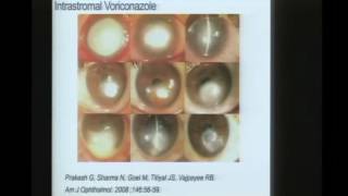 Innovations in Fungal Keratitis [upl. by Alag174]