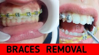 Dental braces removal and retainer on the same day [upl. by Filide]