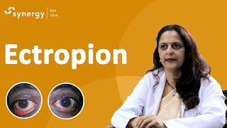 What Is Ectropion Ectropion Causes Symptoms and Treatment [upl. by Imrots]