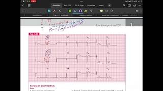 Cardiac axis deviation 🖤 [upl. by Elaen951]