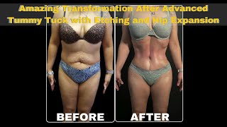 Hourglass Tummy Tuck AB Etching Hip Expansion  DrCortes  Houston TX [upl. by Ennaylime503]