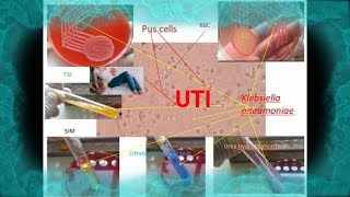 Pus cells Klebsiella in Urine of Urinary tract infection UTI patient [upl. by Reve]