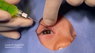 Probing of Nasolacrimal Duct with Fluorescein Irrigation [upl. by Linet]