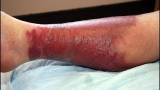 Medical Index  The Treatment of Cellulitis [upl. by Dey519]