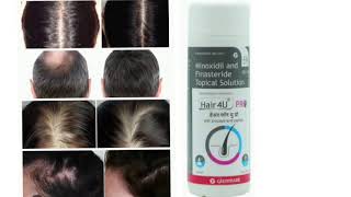 Hair 4U PRO Topical Solution Minoxidil and Finasteride Topical Solution [upl. by Philippine948]