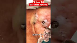 Crazy 10 Year Old BLACKHEADS REMOVAL shorts [upl. by Williamsen]