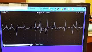 hypoglossal myokymia 3 [upl. by Ytsenoh]