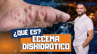 QUE ES LA DISHIDROSIS  ECZEMA DISHIDROTICO  COMO TRATAR EL ECCEMA DISHIDROTICO  DAVID CAMPOS [upl. by Karlik]