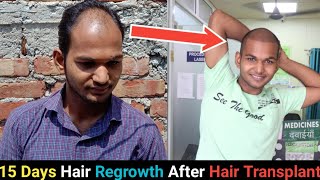 15 Days Hair Regrowth Time Lapse After Hair Transplant In India 2020। [upl. by Ilonka]