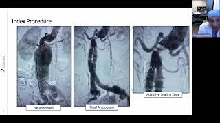 ALTO Stent Graft  Case Review MM2738 US Rev 01 [upl. by Enilarac]