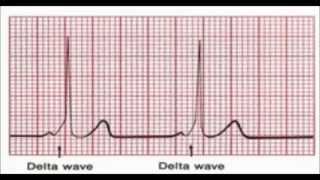 In your EKG How to Identify Delta wave in WPW What Is [upl. by Harv483]