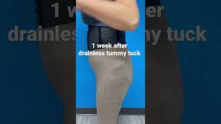 Drainless Tummy Tuck Recovery  1 week after surgery [upl. by Akerley]