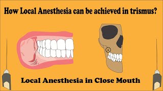 Close Mouth Mandibular block  Vazirani Akinosi technique [upl. by Janetta]